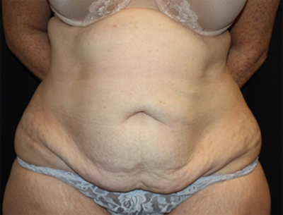 Tummy Tuck Before & After Patient #22618