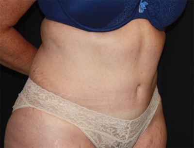 Tummy Tuck Before & After Patient #22618