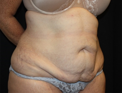 Tummy Tuck Before & After Patient #22618