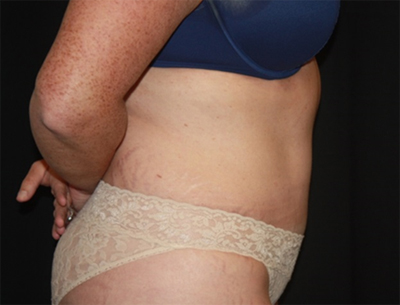 Tummy Tuck Before & After Patient #22618