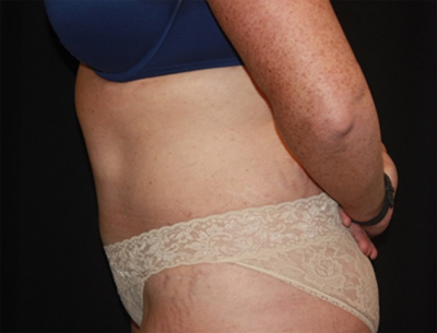 Tummy Tuck Before & After Patient #22618