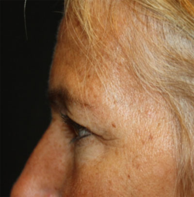 Blepharoplasty and Brow Lift Before & After Patient #20269