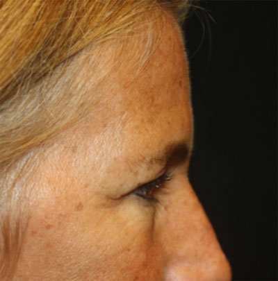 Blepharoplasty and Brow Lift Before & After Patient #20269