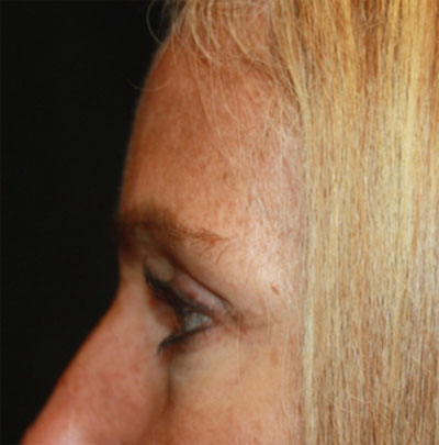 Blepharoplasty and Brow Lift Before & After Patient #20269