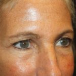 Blepharoplasty and Brow Lift Before & After Patient #20269