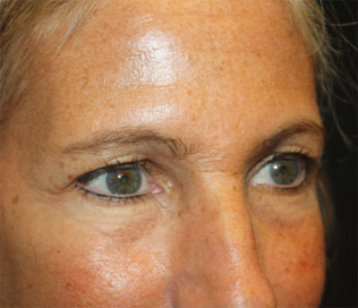 Blepharoplasty and Brow Lift Before & After Patient #20269