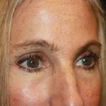 Blepharoplasty and Brow Lift Before & After Patient #20269