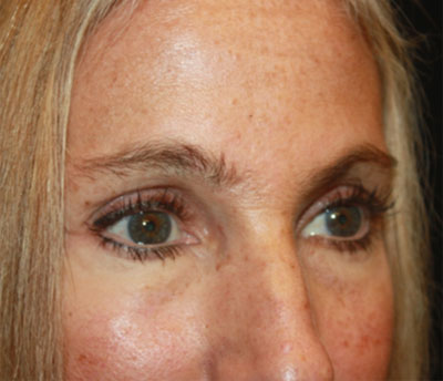 Blepharoplasty and Brow Lift Before & After Patient #20269