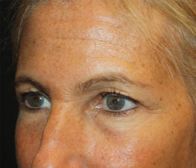 Blepharoplasty and Brow Lift Before & After Patient #20269