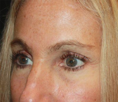 Blepharoplasty and Brow Lift Before & After Patient #20269