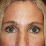 Blepharoplasty and Brow Lift Before & After Patient #20269