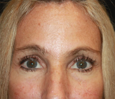 Blepharoplasty and Brow Lift Before & After Patient #20269