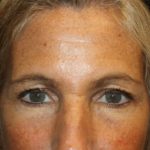 Blepharoplasty and Brow Lift Before & After Patient #20269