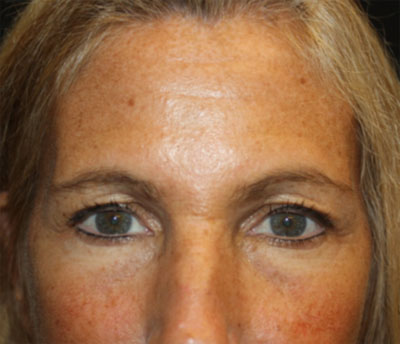 Blepharoplasty and Brow Lift Before & After Patient #20269