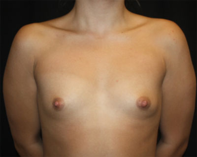 Breast Augmentation - Shaped Silicone Implants Before & After Patient #20519