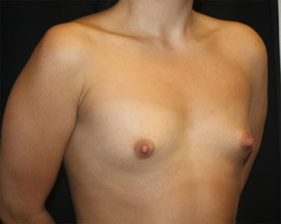 Breast Augmentation - Shaped Silicone Implants Before & After Patient #20519