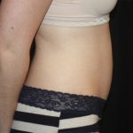 Tummy Tuck Before & After Patient #19996
