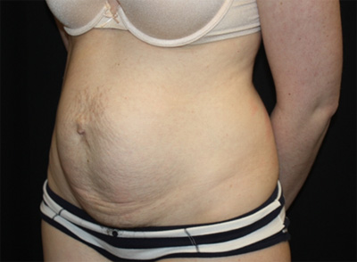 Tummy Tuck Before & After Patient #19996