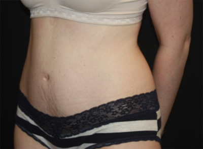 Tummy Tuck Before & After Patient #19996