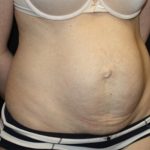 Tummy Tuck Before & After Patient #19996