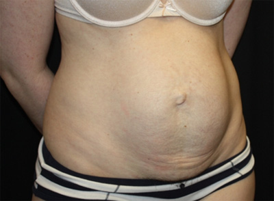 Tummy Tuck Before & After Patient #19996