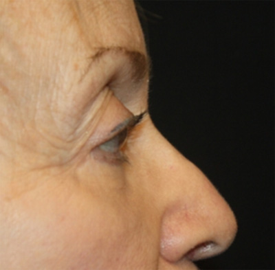 Blepharoplasty and Brow Lift Before & After Patient #20280