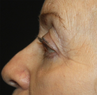 Blepharoplasty and Brow Lift Before & After Patient #20280