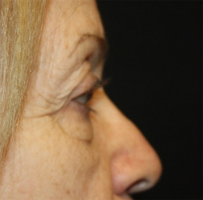 Blepharoplasty and Brow Lift Before & After Patient #20280