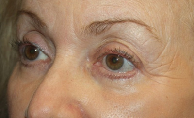 Blepharoplasty and Brow Lift Before & After Patient #20280