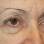 Blepharoplasty and Brow Lift Before & After Patient #20280