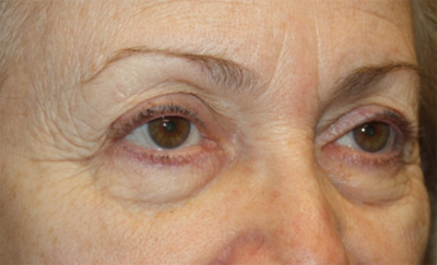 Blepharoplasty and Brow Lift Before & After Patient #20280