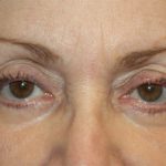 Blepharoplasty and Brow Lift Before & After Patient #20280