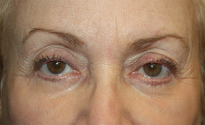 Blepharoplasty and Brow Lift Before & After Patient #20280