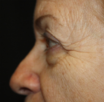 Blepharoplasty and Brow Lift Before & After Patient #20280