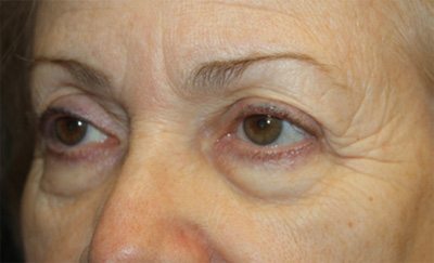 Blepharoplasty and Brow Lift Before & After Patient #20280