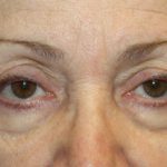 Blepharoplasty and Brow Lift Before & After Patient #20280