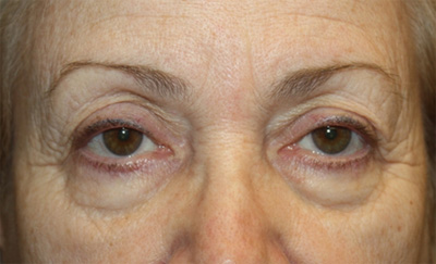 Blepharoplasty and Brow Lift Before & After Patient #20280