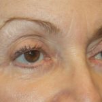 Blepharoplasty and Brow Lift Before & After Patient #20280