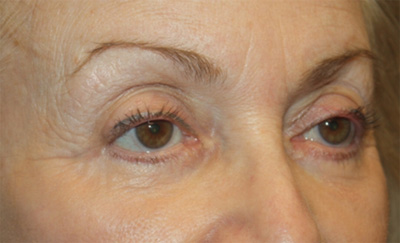 Blepharoplasty and Brow Lift Before & After Patient #20280