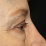 Blepharoplasty Before & After Patient #20207