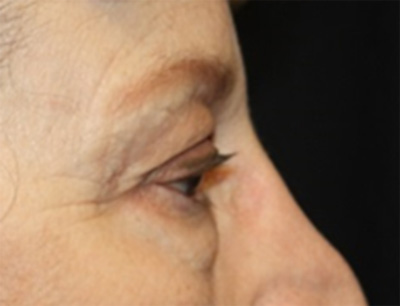 Blepharoplasty Before & After Patient #20207