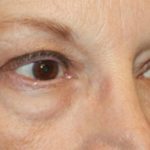 Blepharoplasty Before & After Patient #20207