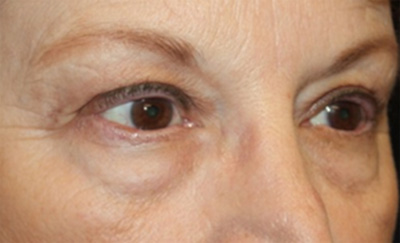 Blepharoplasty Before & After Patient #20207