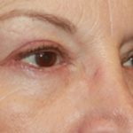 Blepharoplasty Before & After Patient #20207