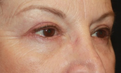 Blepharoplasty Before & After Patient #20207