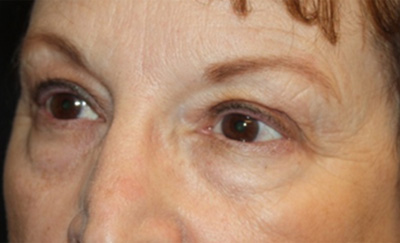 Blepharoplasty Before & After Patient #20207