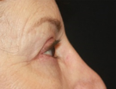 Blepharoplasty Before & After Patient #20207