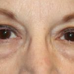 Blepharoplasty Before & After Patient #20207