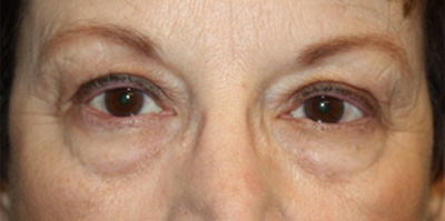 Blepharoplasty Before & After Patient #20207