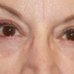 Blepharoplasty Before & After Patient #20207